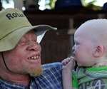Albinism Causes