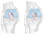 Anterior Cruciate Ligament (ACL) Injury