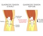 Quadriceps Tendon Rupture