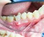What is a Dental Abscess?
