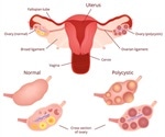 Polycystic Ovary Syndrome and Metabolic Syndrome