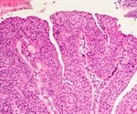 Bladder Cancer Histopathology