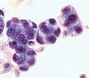Rare case of pancreatic Hodgkin lymphoma is often misdiagnosed as pancreatic adenocarcinoma