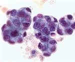 Lipid droplet protein perilipin 2 linked to poor prognosis in lung cancer