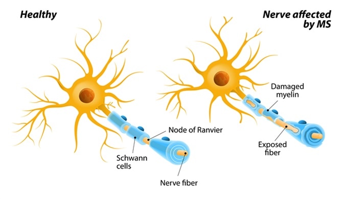 Multiple sclerosis or MS. autoimmune disease. the nerves of the brain and spinal cord are damaged by one