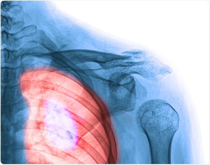 Lung cancer. Image Credit: Wonderisland / Shutterstock