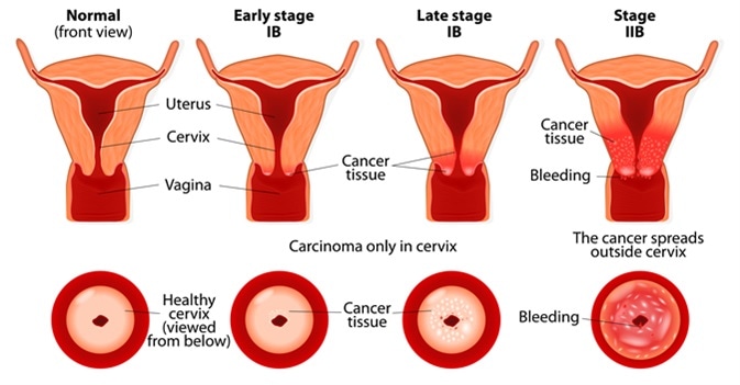 Cervical cancer stages. Image Credit: Designua / Shutterstock