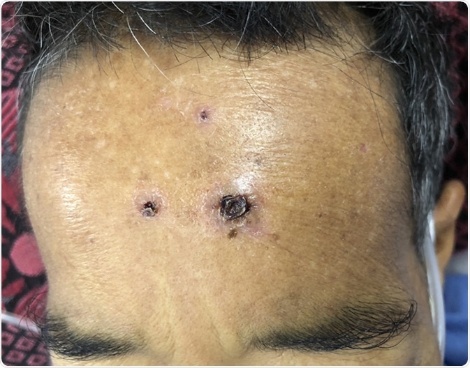 Multiple black crusts at forehead in middle age man who presented with severe sepsis and septic shock. Image Credit: TisforThan / Shutterstock