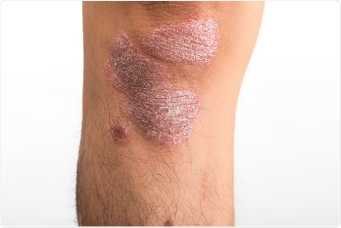 A study in the Journal of Investigative Dermatology tested several high-fat, low-carb ketogenic diets and found those high in coconut and palm oils exacerbated psoriasiform-like skin inflammation in mice. Image Credit: Shutterstock