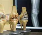 Osteoarthritis Complications