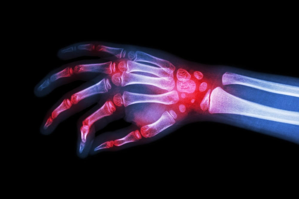 rheumatoid arthritis