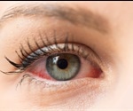 Types of Eye Allergy