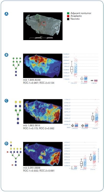 Quantification of N-glycan signatures from regional areas on tissue. Statistical testing was done comparing nontumor adjacent and anaplastic regions (ROC-1) or anaplastic versus necrotic (ROC-2). A Photomicrograph depicting areas selected for measuring relative abundance of N-glycan expression. B A high mannose (Man9) structure distinguishing nontumor adjacent compared to anaplastic tumor or necrotic regions. C A biantennary N-glycan defining necrotic regions with low expression in nontumor adjacent and anaplastic. D A tetrantennary fucosylated structure with low expression in adjacent nontumor and increasing expression in anaplastic and necrotic tissues regions.