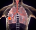 Lung cancer screening using Google AI proves to be successful