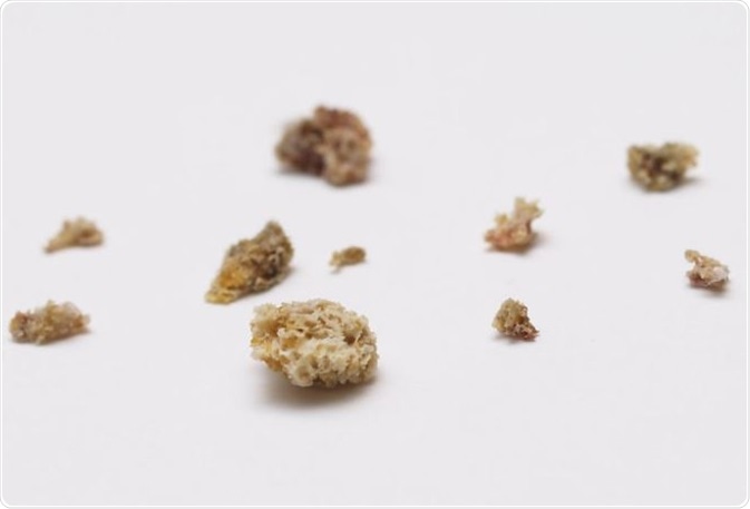 Bisphosphonate-associated osteonecrosis of the jaw. Credit paparutzi / Flickr