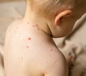Vanderbilt and Parse Biosciences team up to develop antibody treatments for measles