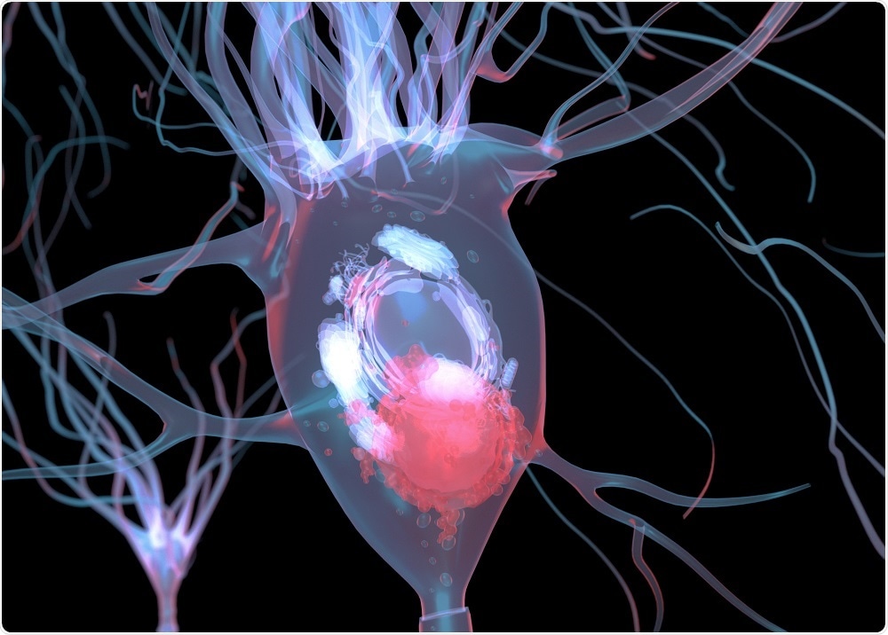 This image shows a motor neuron with Lewy bodies, a pathological sign of Parkinson