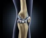 Personalized knee replacement: an interview with Dr Martin, Preferred Orthopedics of the Palm Beaches