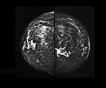 3D mammograms increasing in popularity for breast cancer screening in the USA