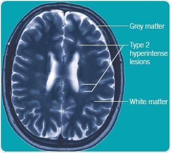 MRI scan of an MS brain T2 weighted axial view of MRI brain scan from a patient with relapsing-remitting MS. Multiple white matter T2 hyperintense lesions in orientation and distribution typical for MS.