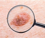 UK, skin cancer specialists to check out moles