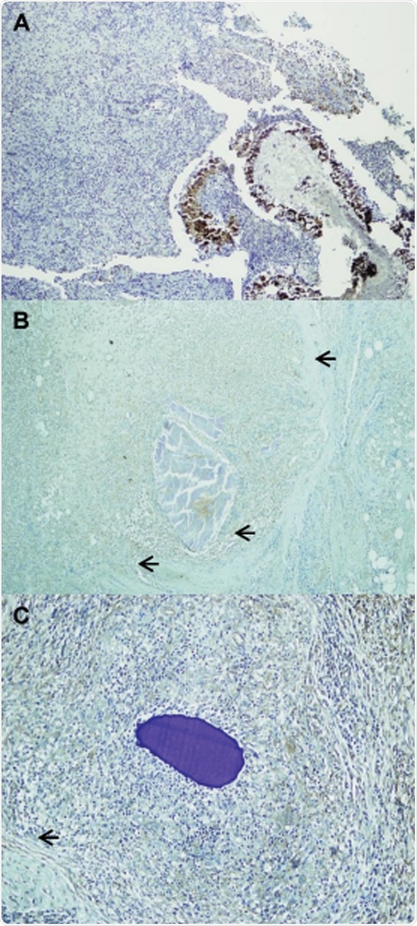 Scientists study immune molecules inside mycetoma grains
