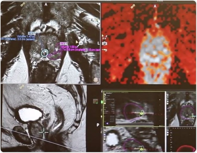 Art Rastinehad, DO, Associated Professor of Urology and Radiology at the Icahn School of Medicine at Mount Sinai, is leading the first clinical trial of gold nanoparticles to treat prostate cancer.