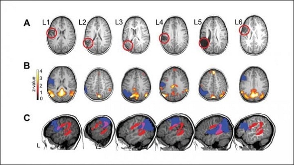 Structural and functional reorganization in the brain predicts language production