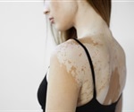 Vitiligo Treatment