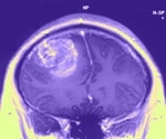 What is Glioblastoma Multiforme?