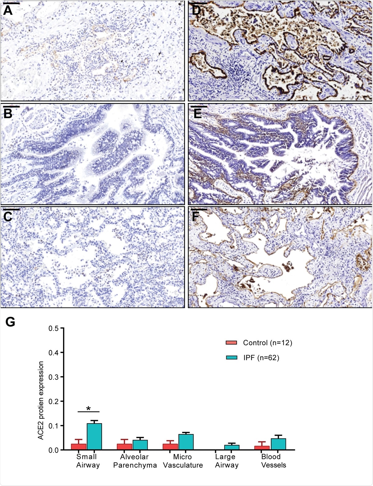 ACE2 and ITGB6 protein expression in IPF lung sections. (A-C) IPF lung sections stained for ACE2: (A) small airway, (B) large airway and (C) lung parenchyma. (D-F): IPF lung sections stained for αvβ6: (D) small airway, (E) large airway and (F) lung parenchyma. (G) semi-quantitative evaluation of ACE2 scoring among control and IPF sections (both the percentage of staining and staining intensity of ACE2 expression;0-Negative; 1-0–⩽10%; 2-11–⩽25%; 3- ⩽26%). Significant differences between IPF and control were calculated using Tukey HSD test, p-value < 0.05 *. Scale bar = 100μm.
