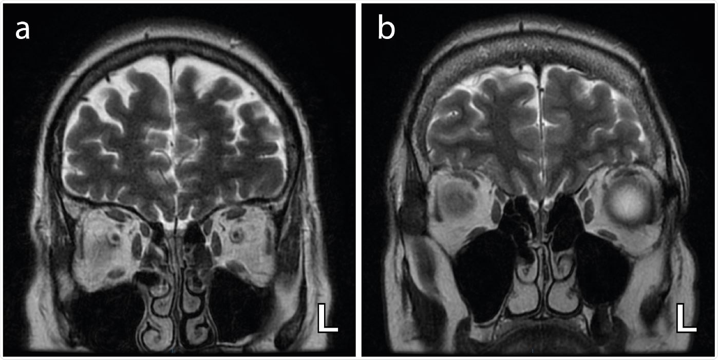 Axial T2-weighted coronal images demonstrating bilateral and complete obliteration of the olfactory clefts (a) with no associated olfactory bulb asymmetry and (b) with asymmetry of the olfactory bulbs (left (L) bulb relatively enlarged) .