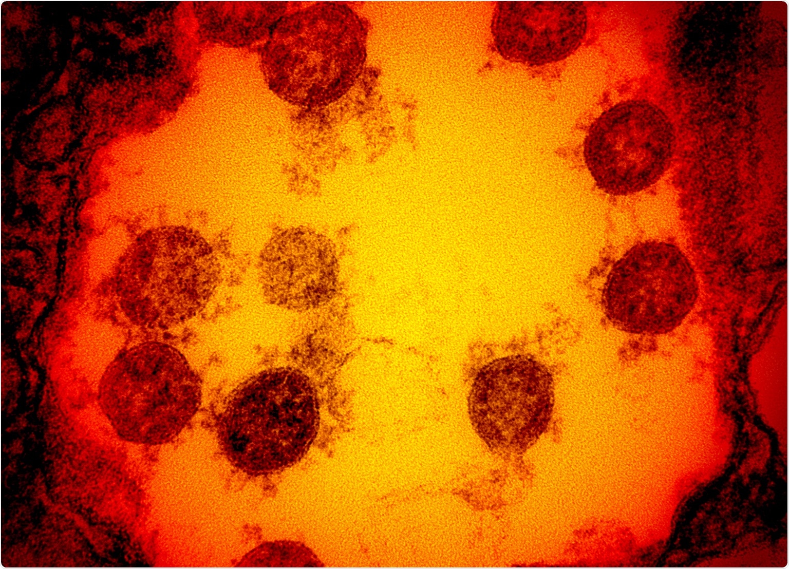 Study: Determining the relationship between SARS-CoV-2 infection, dopamine, and COVID-19 complications.