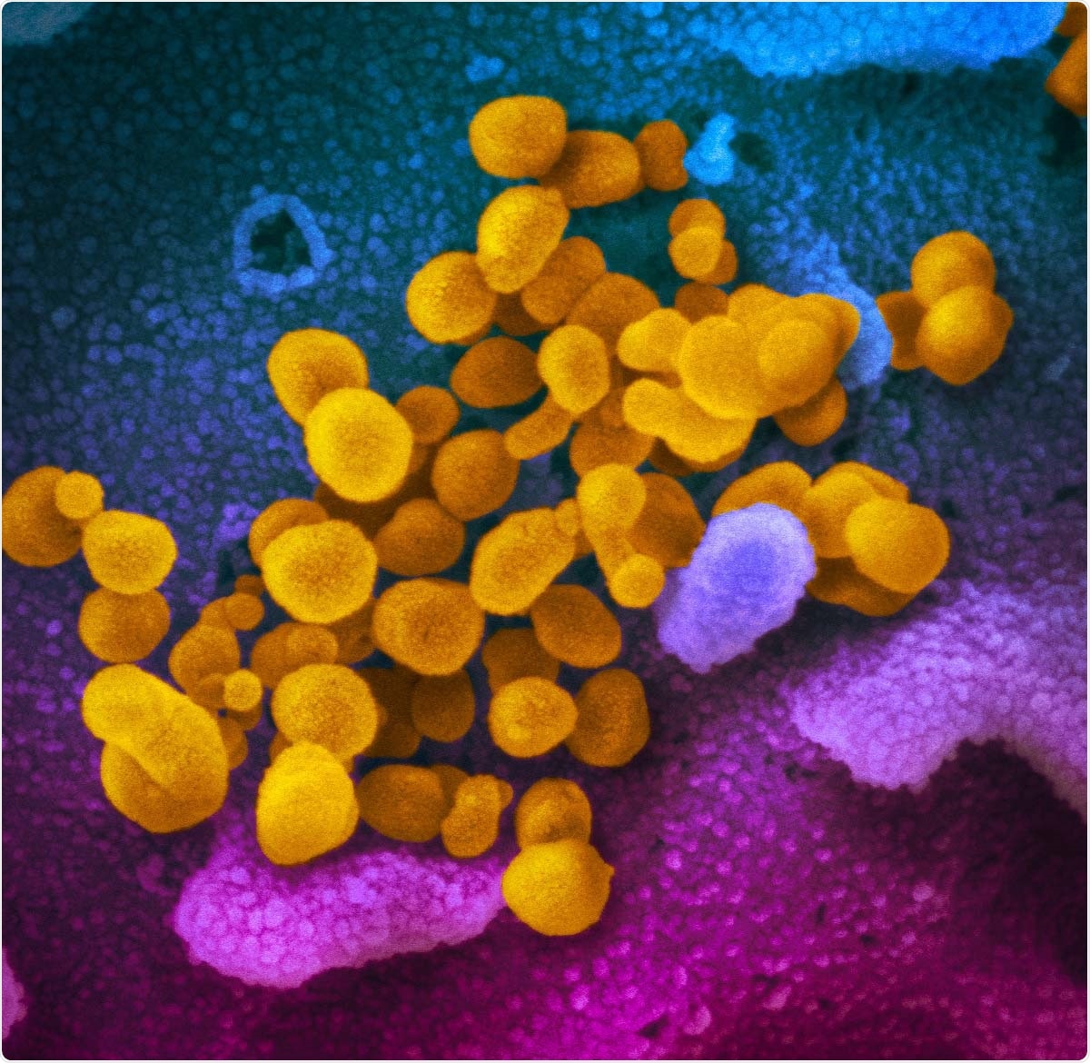 Study: Association of social distancing and masking with risk of COVID-19. This scanning electron microscope image shows SARS-CoV-2 (yellow)—also known as 2019-nCoV, the virus that causes COVID-19—isolated from a patient in the U.S., emerging from the surface of cells (blue/pink) cultured in the lab. Image captured and colorized at NIAID