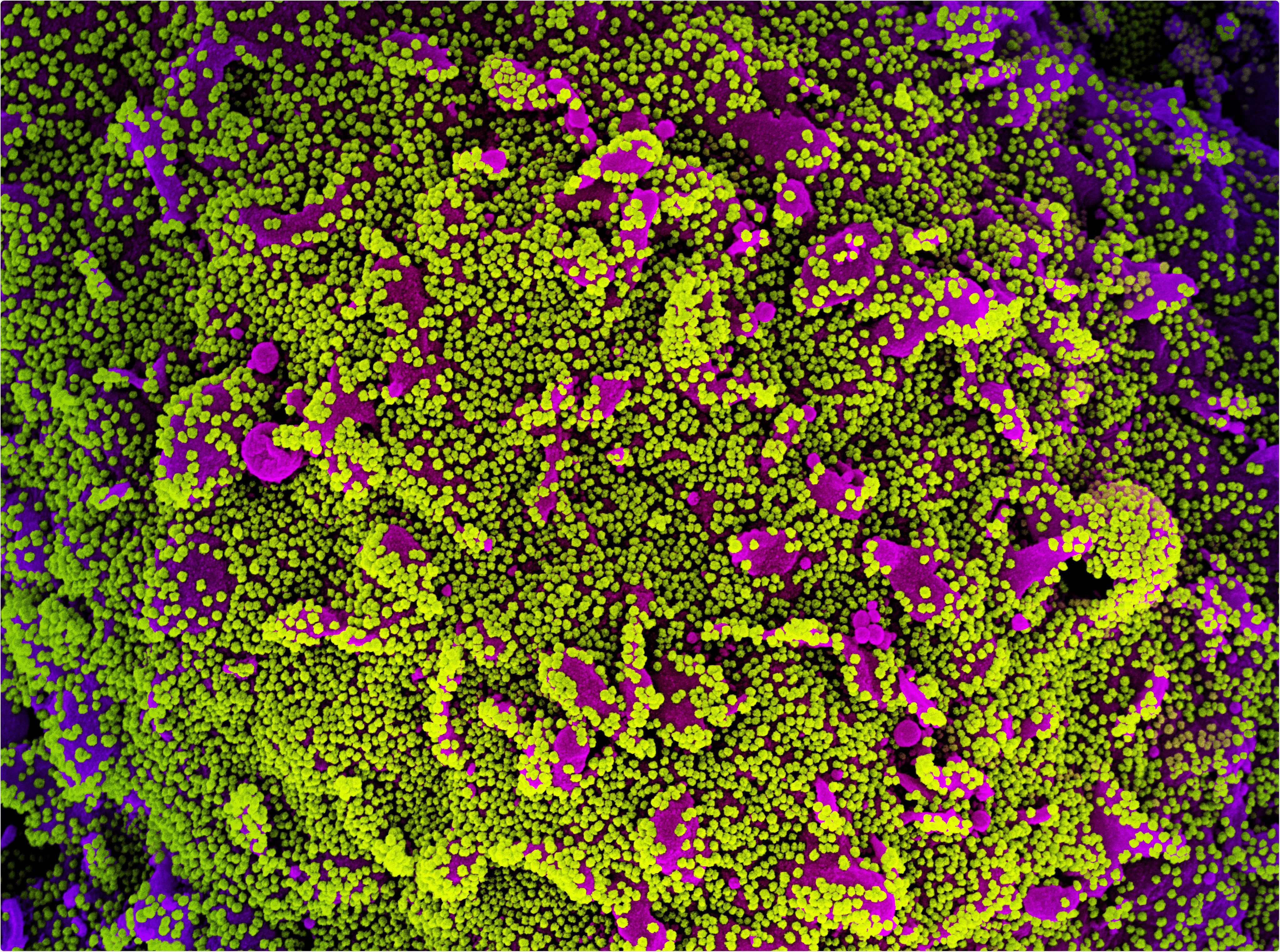 Colorized scanning electron micrograph of a cell (purple) heavily infected with SARS-CoV-2 virus particles, isolated from a patient sample. Image captured at the NIAID Integrated Research Facility (IRF) in Fort Detrick, Maryland. Credit: NIAID