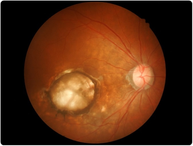 Age-related macular degeneration (AMD). Memorisz / Shutterstock
