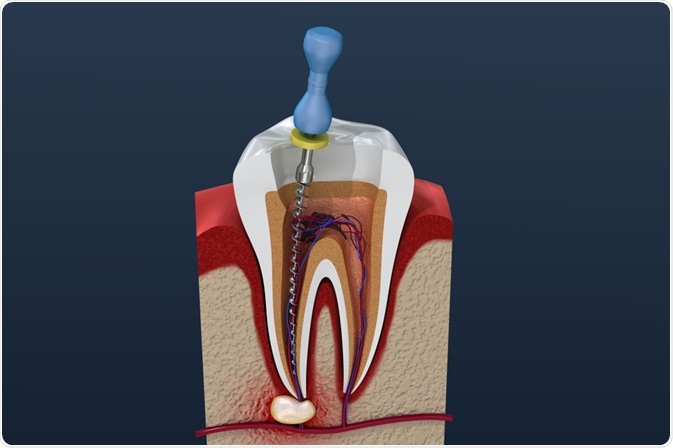 Root canal removal processs