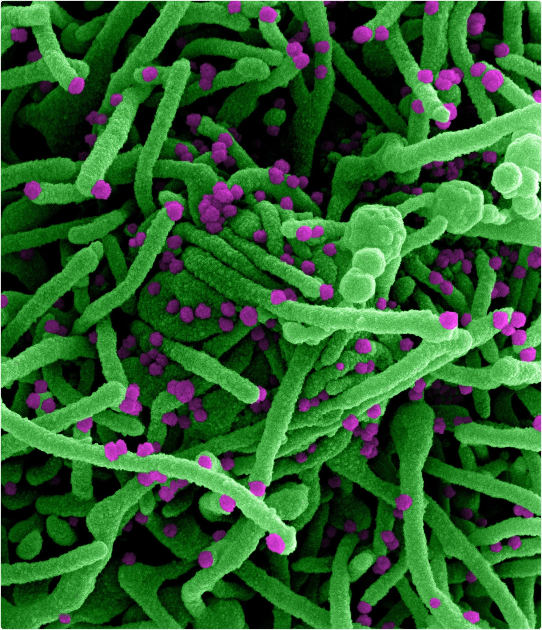 Novel Coronavirus SARS-CoV-2 Colorized scanning electron micrograph of a cell (green) infected with SARS-COV-2 virus particles (purple), isolated from a patient sample. Image captured at the NIAID Integrated Research Facility (IRF) in Fort Detrick, Maryland. Credit: NIAID