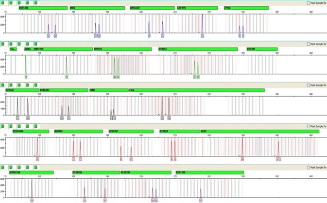 Profile generated from a treated buccal punch us-ing GlobalFiler® Express at 26 cycles.