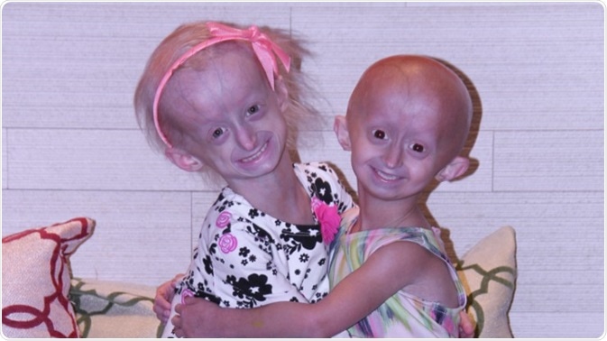 Progeria