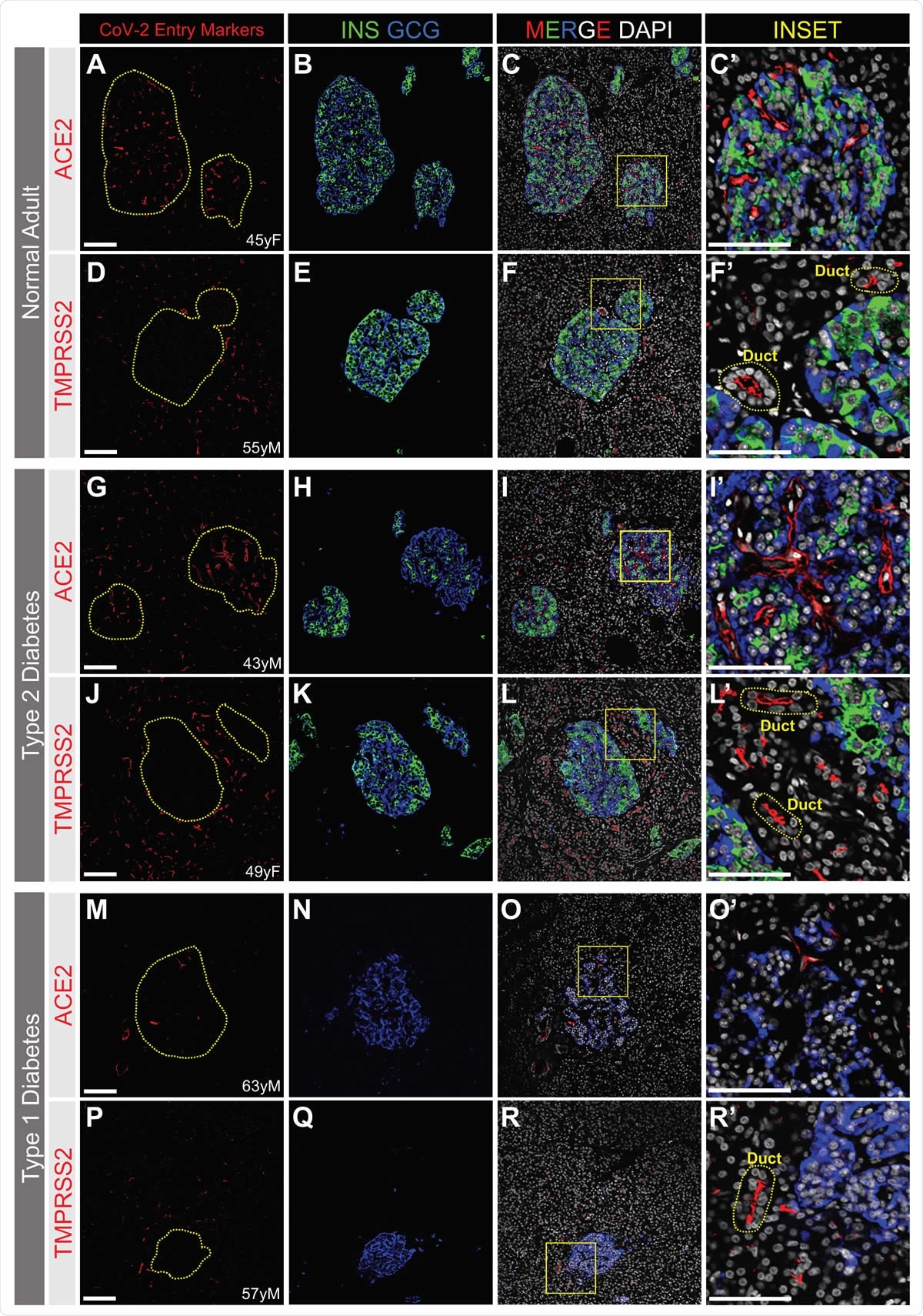 ACE2 and TMPRSS2 Protein is Not Detected by Immunofluorescence in a or b Cells from Normal, T2D or T1D adult donors. SARS-CoV-2 cell entry markers ACE2 (antibody ab15348) and TMPRSS2, both shown in red, are not detected in islet a cells (GCG, blue) or b cells (INS, green) in pancreatic sections from adult donors without diabetes (A-H) or donors with type 2 (I-N) or type 1 (O-V) diabetes. Insets are depicted by a yellow box. DAPI (white). Scale bars are 100 μm (A-V) and 25 μm (Insets). Human islet and pancreatic donor information is available in Table S1 (A-D, donors N3, N7, N9, N8; E-H, donors N14, N12, N11, N10; I-L, donors 2L, 2B, 2G, 2I; M-N, donors 2H, 2G; O-R, donors 1B, 1D, 1C, 1A; S-V, donors 1H, 1K, 1J, 1G).