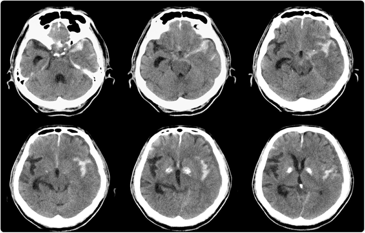 Computed tomography (CT) of brain : Left SAH (Subarachnoid hemorrhage). Image Credit: MossStudio / Shutterstock