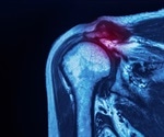 What are Rotator Cuff Injuries?