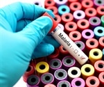 Breakthrough innovation for high sensitivity TB and Malaria diagnostics
