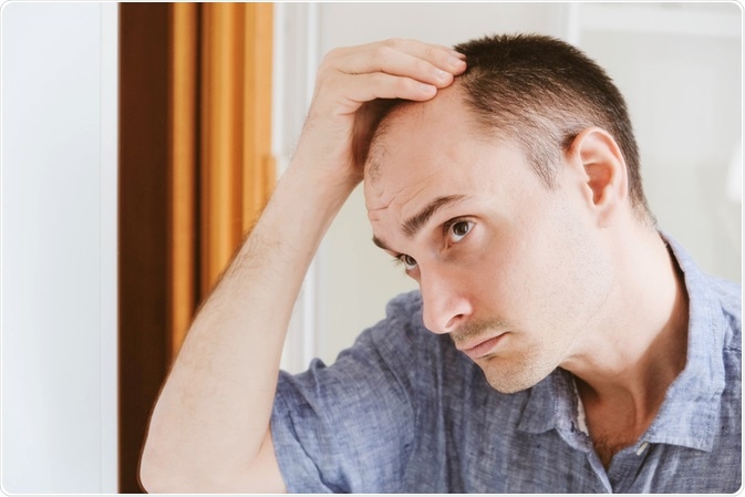 Male Pattern Baldness