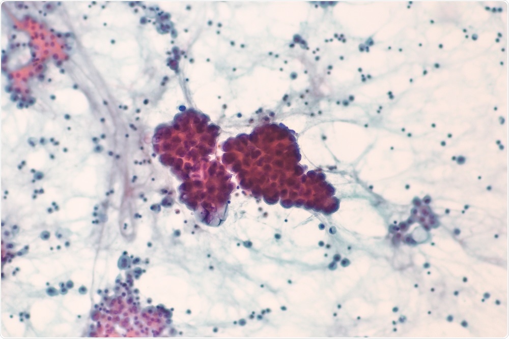 non-small cell lung cancer
