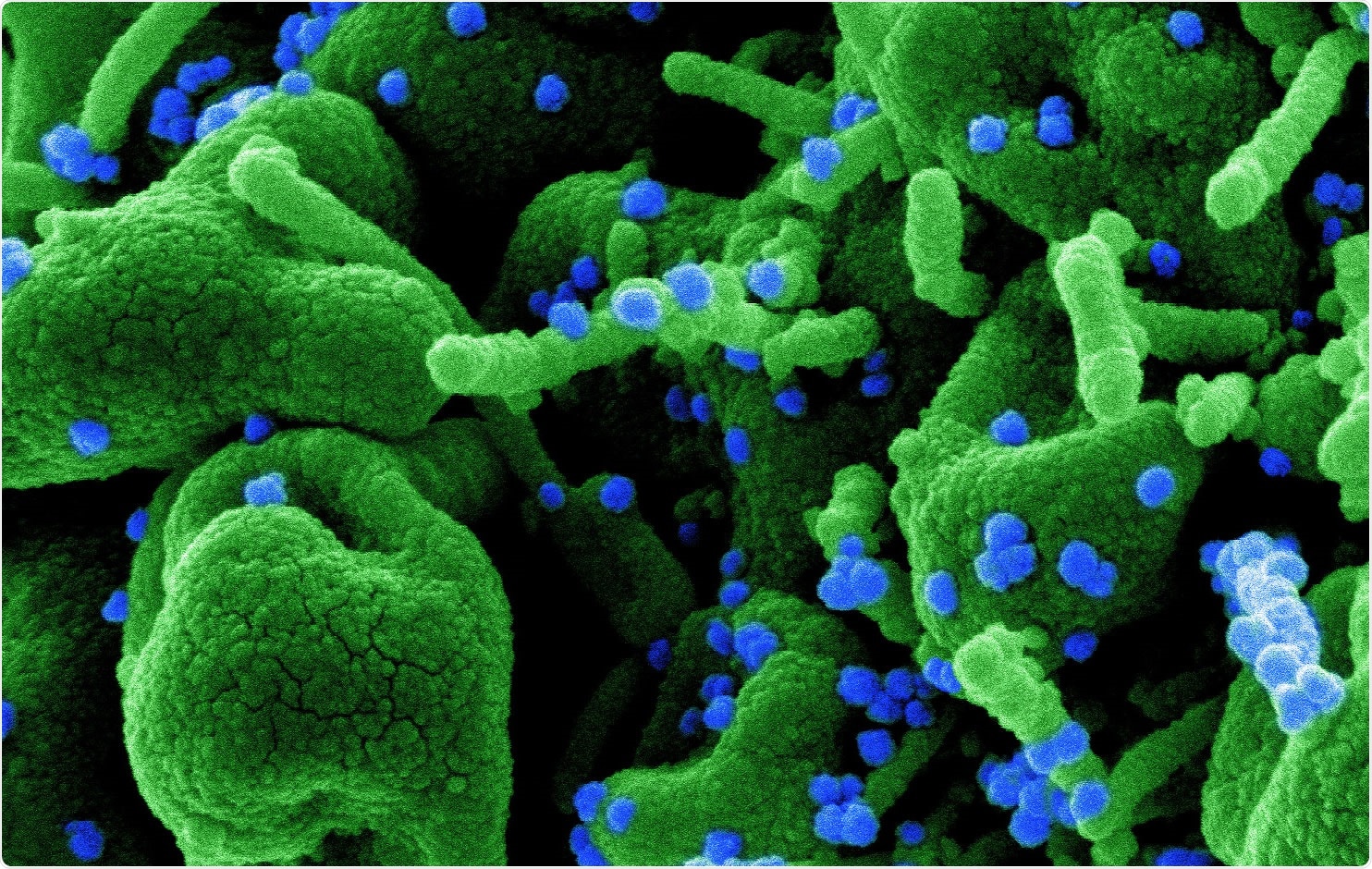 Study: Differential Cytokine Signatures of SARS-CoV-2 and Influenza Infection Highlight Key Differences in Pathobiology. Image Credit: NIAID