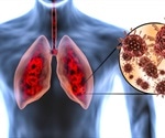 What Does COVID-19 do to the Lungs?