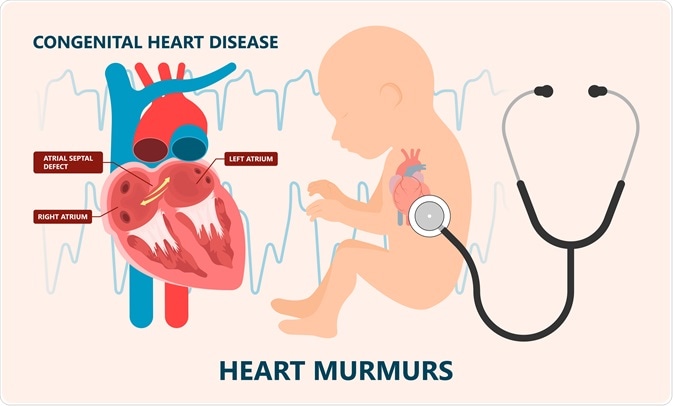 congenital heart disease