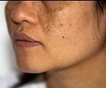 What is Hyperpigmentation?